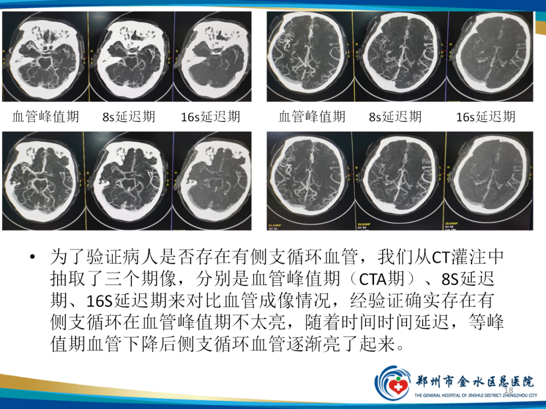 影像PPT - 【PPT】“中风”超时间窗的TA还有救么？-18