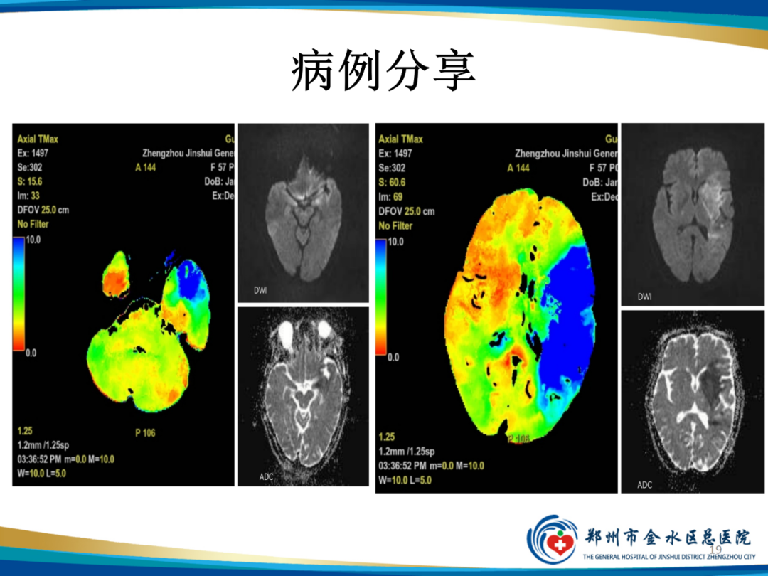 影像PPT - 【PPT】“中风”超时间窗的TA还有救么？-19