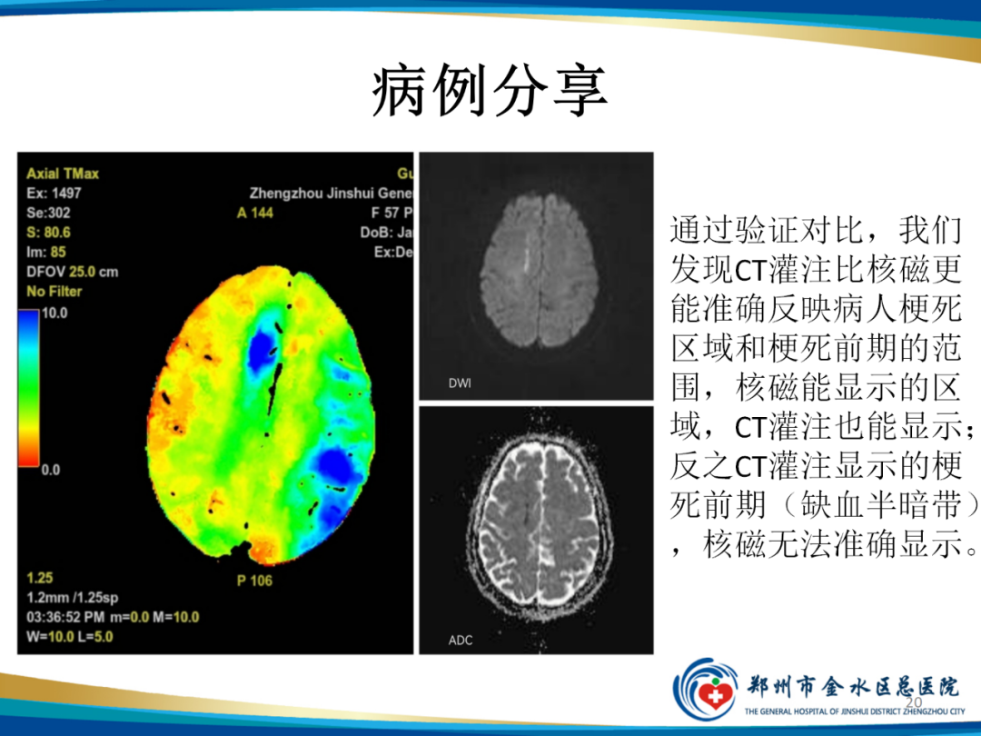 影像PPT - 【PPT】“中风”超时间窗的TA还有救么？-20