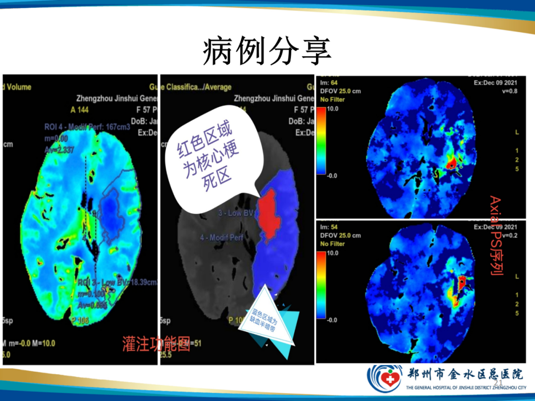 影像PPT - 【PPT】“中风”超时间窗的TA还有救么？-21