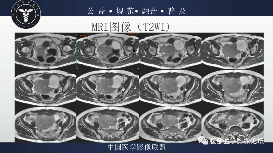 影像PPT - 【病例】卵巢弥漫大B细胞淋巴瘤1例MR影像-5
