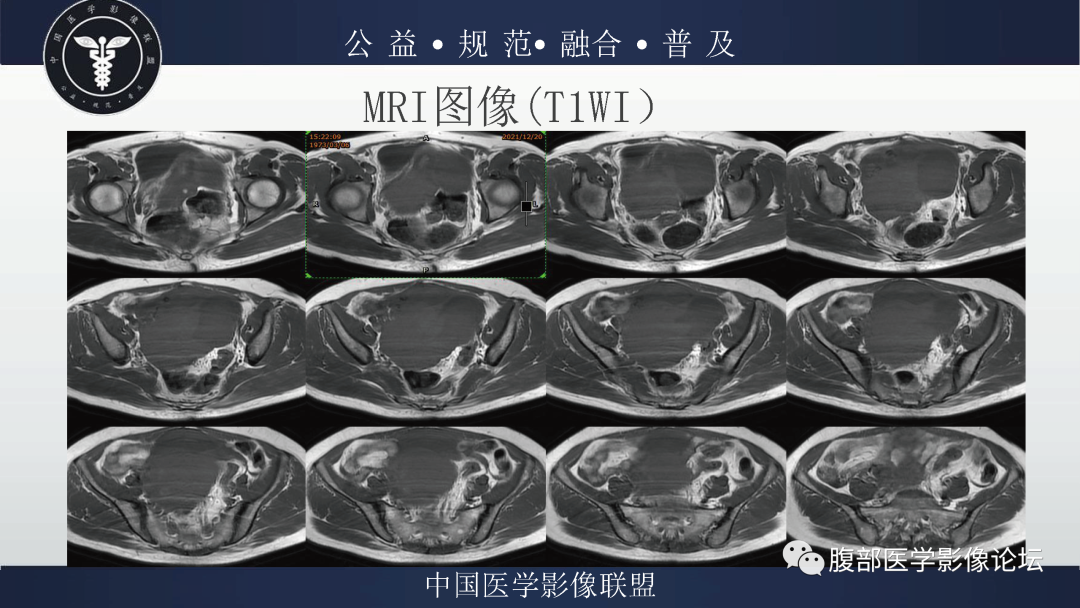 影像PPT - 【病例】卵巢弥漫大B细胞淋巴瘤1例MR影像-6