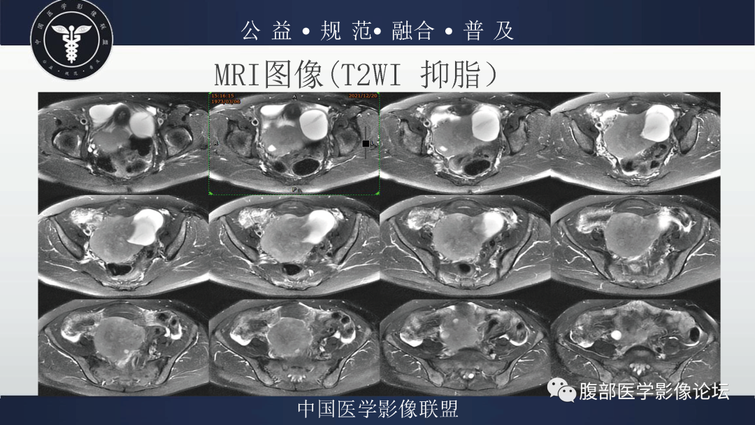 影像PPT - 【病例】卵巢弥漫大B细胞淋巴瘤1例MR影像-7