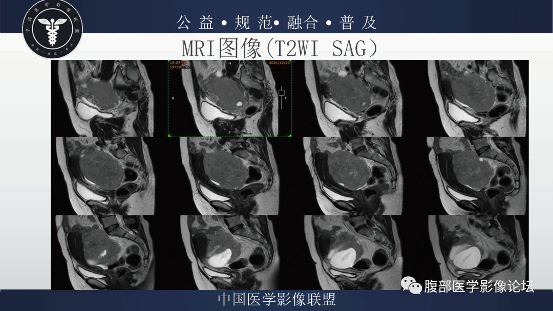 影像PPT - 【病例】卵巢弥漫大B细胞淋巴瘤1例MR影像-9