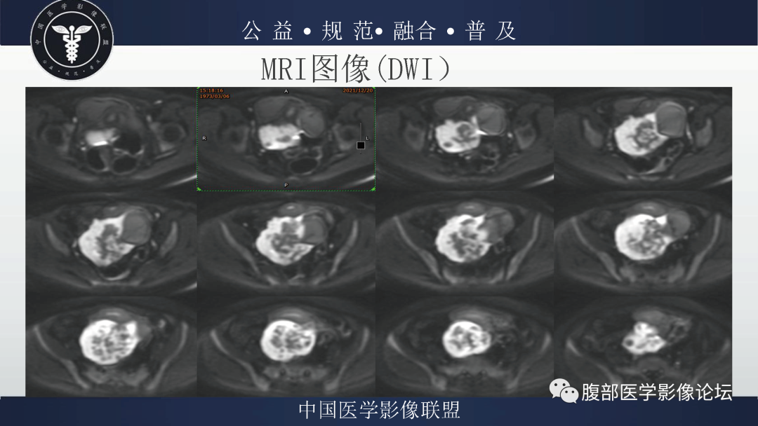 影像PPT - 【病例】卵巢弥漫大B细胞淋巴瘤1例MR影像-8