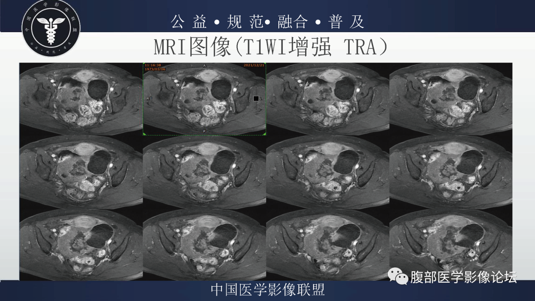 影像PPT - 【病例】卵巢弥漫大B细胞淋巴瘤1例MR影像-10