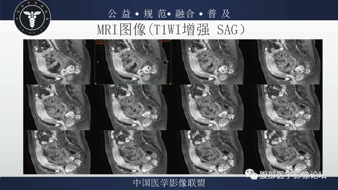 影像PPT - 【病例】卵巢弥漫大B细胞淋巴瘤1例MR影像-11