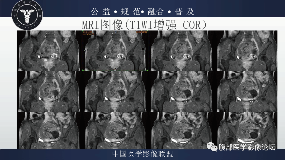 影像PPT - 【病例】卵巢弥漫大B细胞淋巴瘤1例MR影像-12