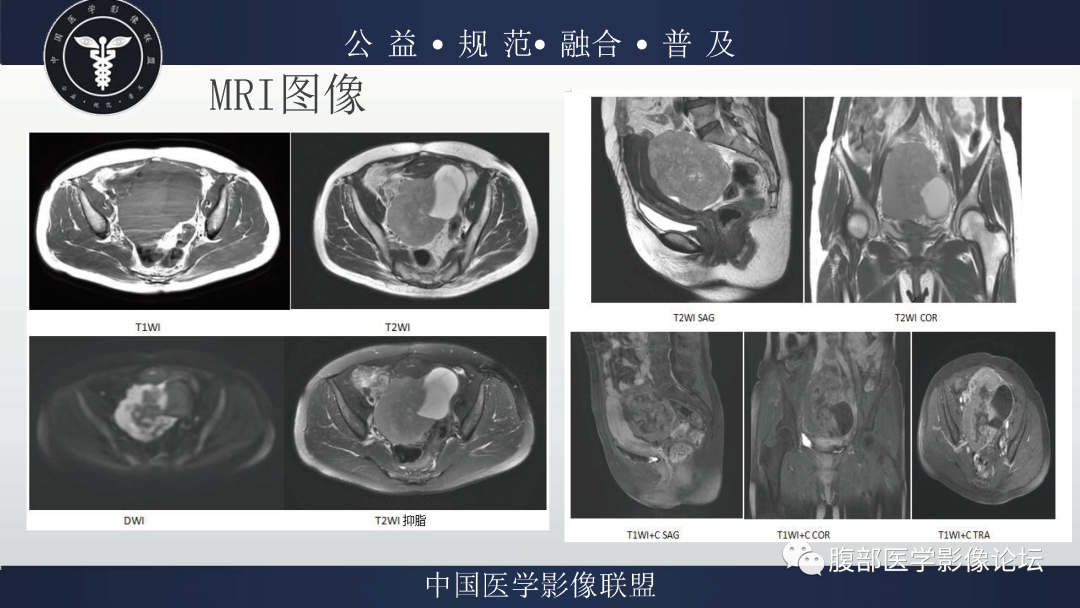 影像PPT - 【病例】卵巢弥漫大B细胞淋巴瘤1例MR影像-13