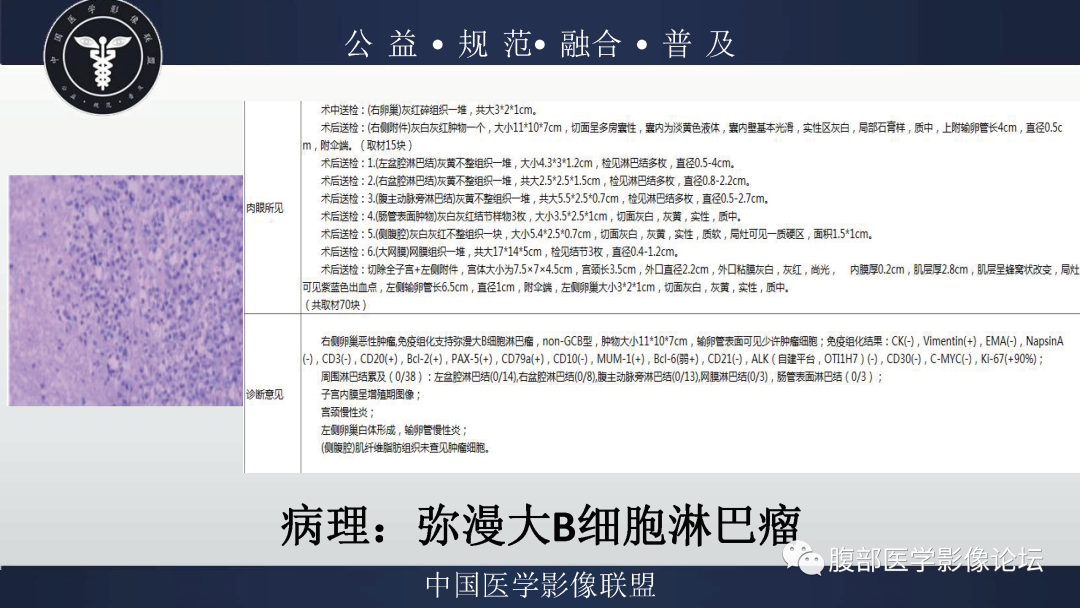影像PPT - 【病例】卵巢弥漫大B细胞淋巴瘤1例MR影像-15