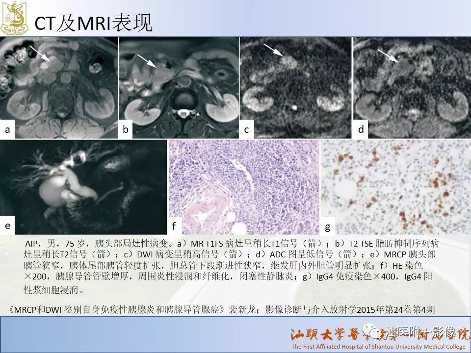 影像PPT - 【PPT】自身免疫性胰腺炎CT及MRI特征-9