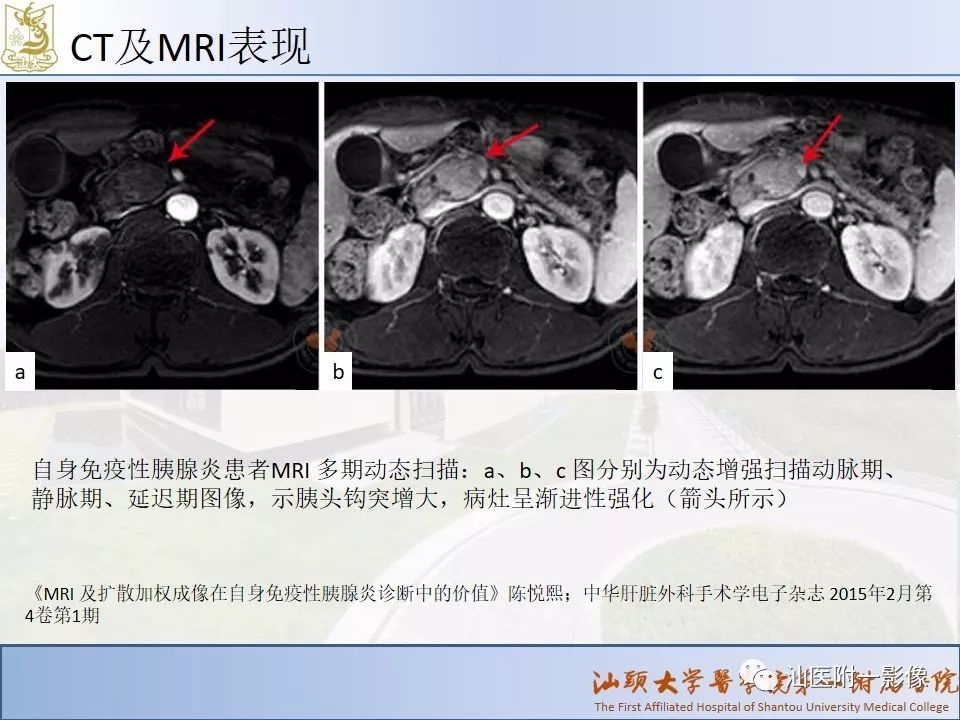 影像PPT - 【PPT】自身免疫性胰腺炎CT及MRI特征-10