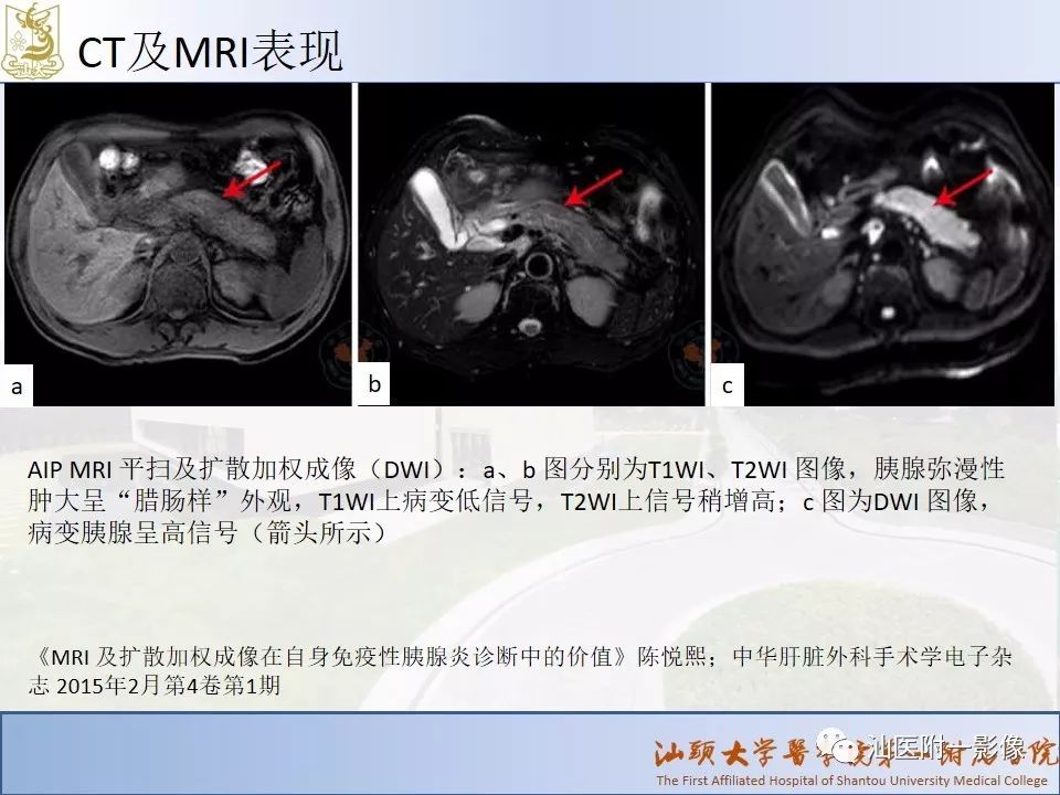 影像PPT - 【PPT】自身免疫性胰腺炎CT及MRI特征-12