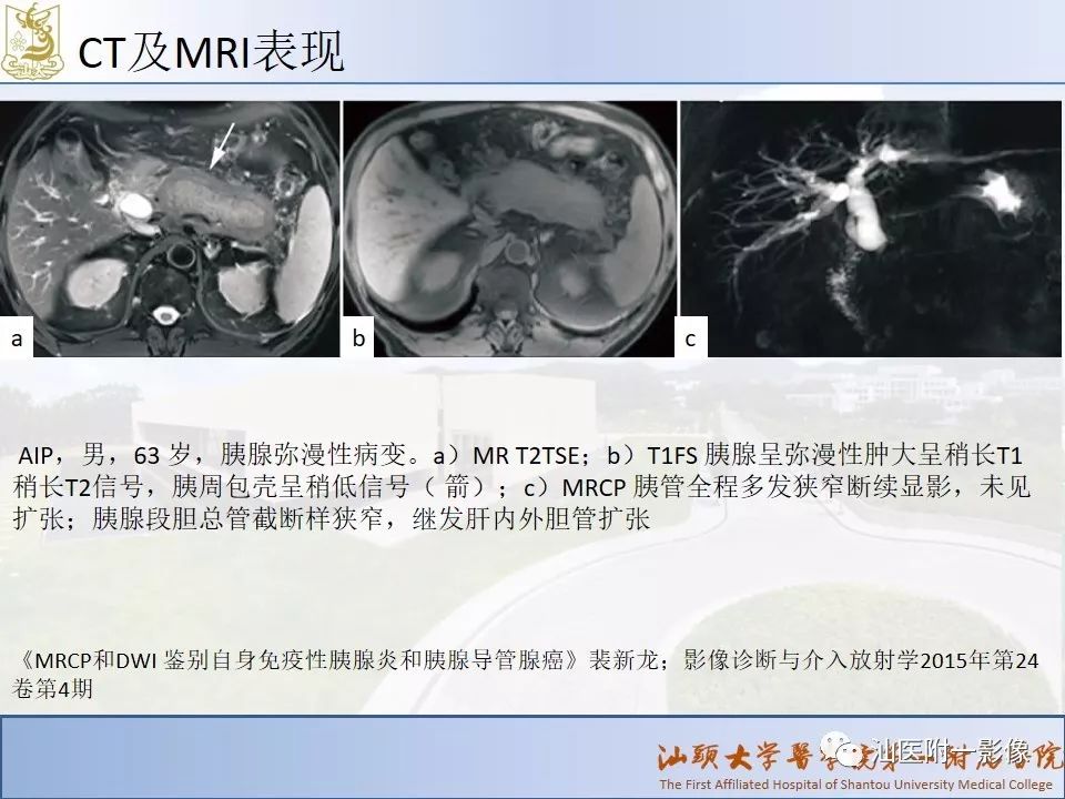 影像PPT - 【PPT】自身免疫性胰腺炎CT及MRI特征-13