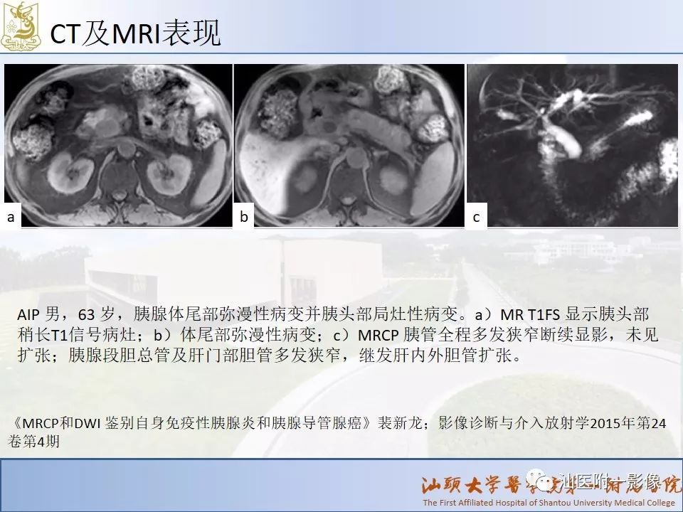 影像PPT - 【PPT】自身免疫性胰腺炎CT及MRI特征-11