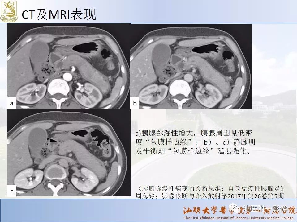 影像PPT - 【PPT】自身免疫性胰腺炎CT及MRI特征-15