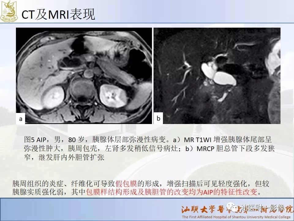 影像PPT - 【PPT】自身免疫性胰腺炎CT及MRI特征-14