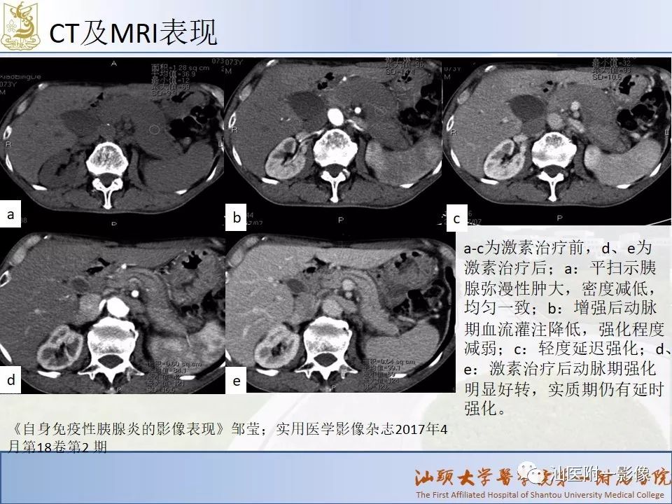 影像PPT - 【PPT】自身免疫性胰腺炎CT及MRI特征-16