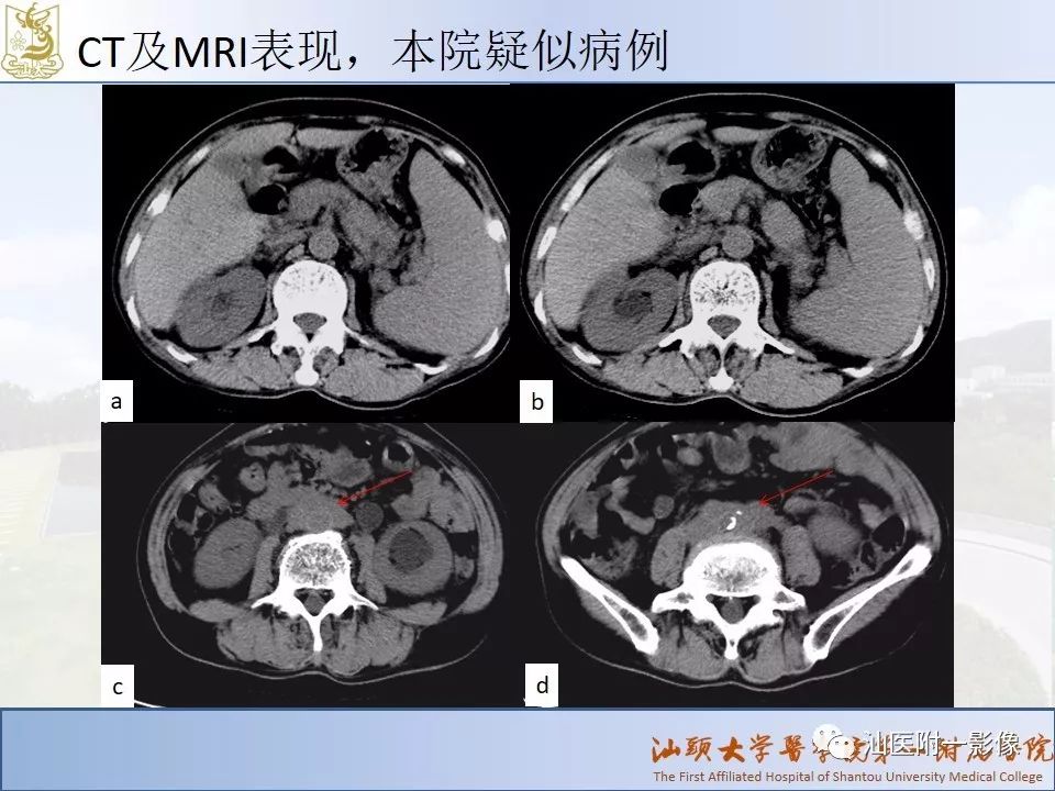 影像PPT - 【PPT】自身免疫性胰腺炎CT及MRI特征-17