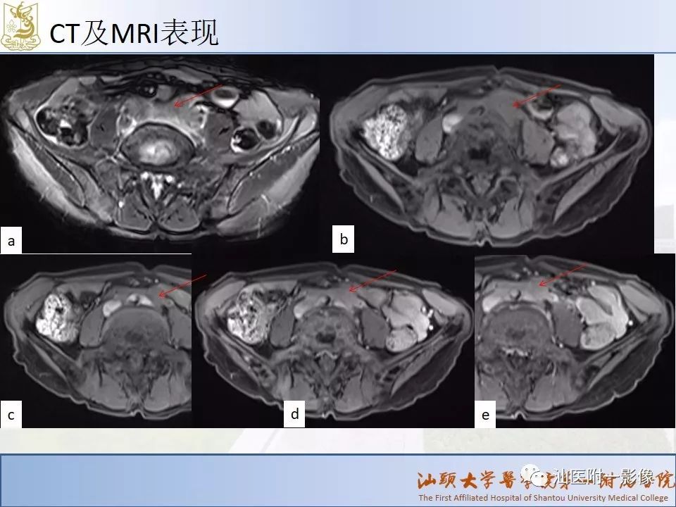 影像PPT - 【PPT】自身免疫性胰腺炎CT及MRI特征-19