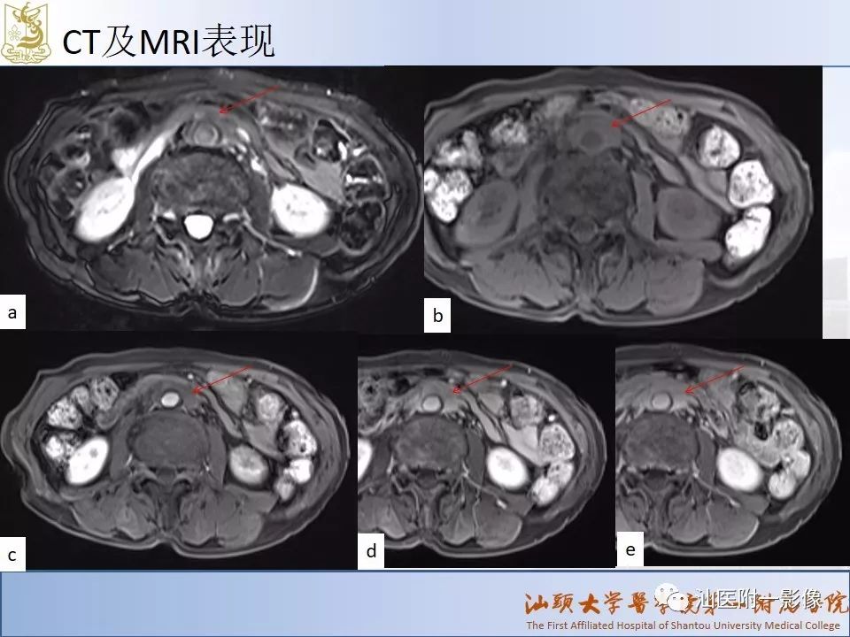 影像PPT - 【PPT】自身免疫性胰腺炎CT及MRI特征-18