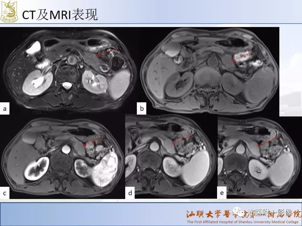 影像PPT - 【PPT】自身免疫性胰腺炎CT及MRI特征-20