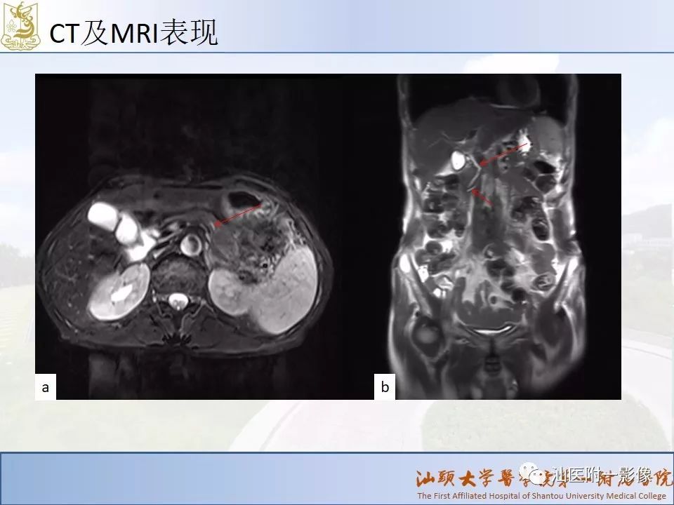 影像PPT - 【PPT】自身免疫性胰腺炎CT及MRI特征-23