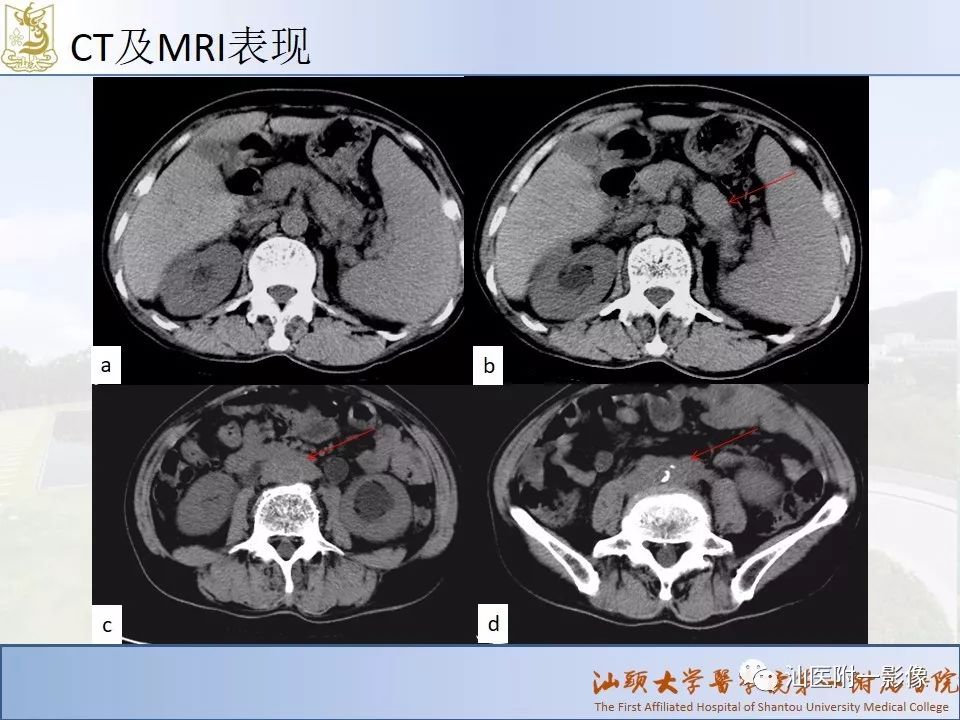 影像PPT - 【PPT】自身免疫性胰腺炎CT及MRI特征-21