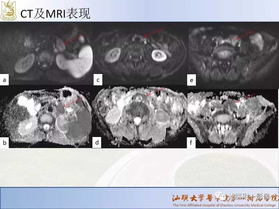 影像PPT - 【PPT】自身免疫性胰腺炎CT及MRI特征-22