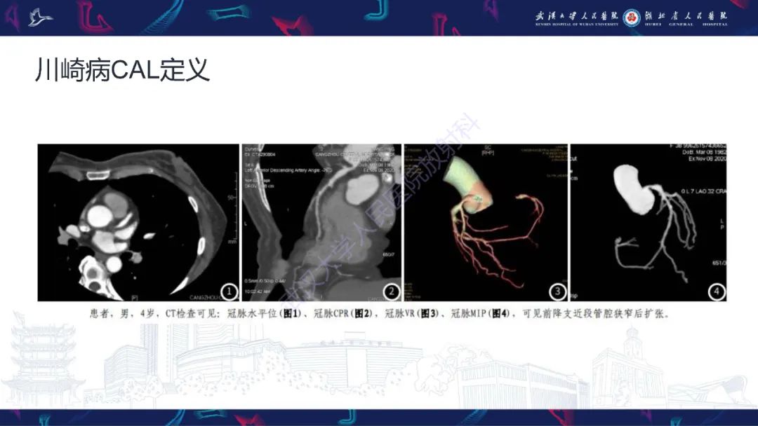 影像PPT - 【PPT】川崎病冠状动脉病变影像诊断-10