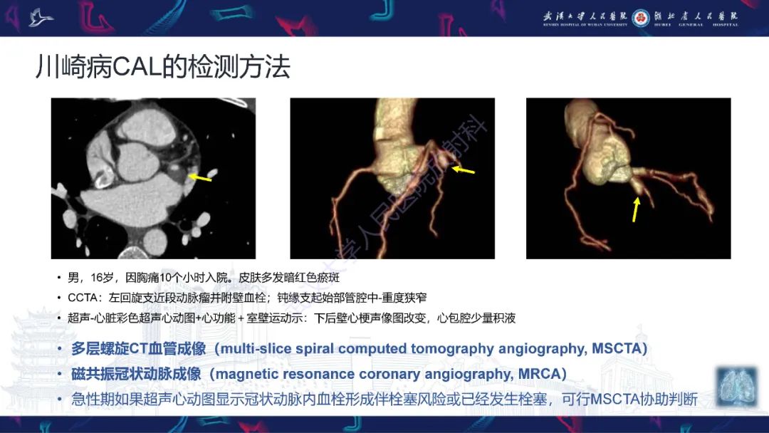 影像PPT - 【PPT】川崎病冠状动脉病变影像诊断-16