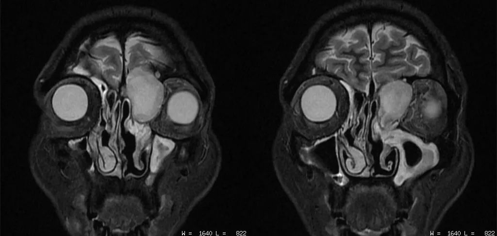 影像PPT - 眼部MRI该如何扫描-3 影像PPT - 眼部MRI该如何扫描-3