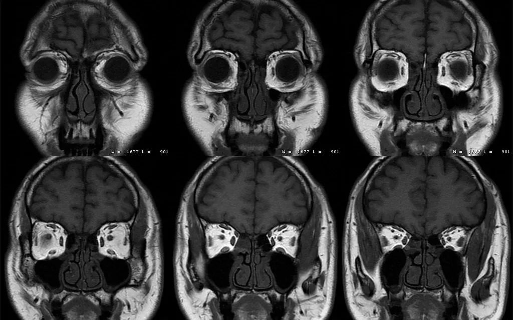 影像PPT - 眼部MRI该如何扫描-2 影像PPT - 眼部MRI该如何扫描-2
