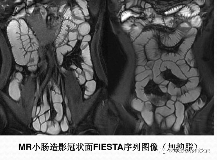 影像PPT - 小肠磁共振造影成像技术&常用序列-4 影像PPT - 小肠磁共振造影成像技术&常用序列-4
