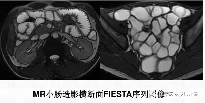 影像PPT - 小肠磁共振造影成像技术&常用序列-3 影像PPT - 小肠磁共振造影成像技术&常用序列-3