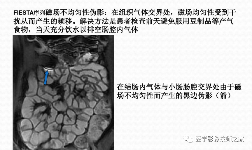 影像PPT - 小肠磁共振造影成像技术&常用序列-5 影像PPT - 小肠磁共振造影成像技术&常用序列-5