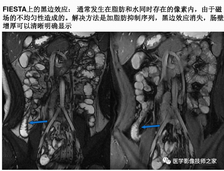 影像PPT - 小肠磁共振造影成像技术&常用序列-6 影像PPT - 小肠磁共振造影成像技术&常用序列-6