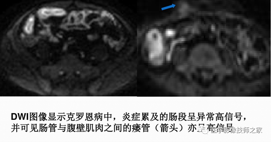影像PPT - 小肠磁共振造影成像技术&常用序列-8 影像PPT - 小肠磁共振造影成像技术&常用序列-8