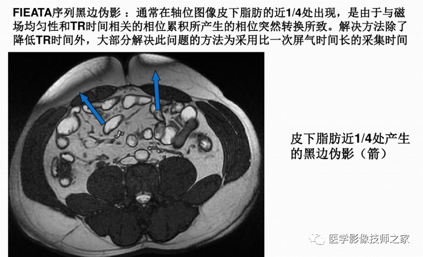 影像PPT - 小肠磁共振造影成像技术&常用序列-7 影像PPT - 小肠磁共振造影成像技术&常用序列-7