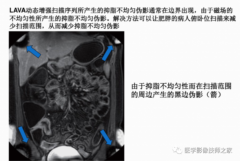 影像PPT - 小肠磁共振造影成像技术&常用序列-10 影像PPT - 小肠磁共振造影成像技术&常用序列-10