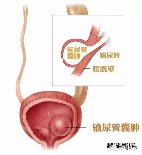 影像PPT - 可怕的“眼镜蛇头征”-8 影像PPT - 可怕的“眼镜蛇头征”-8