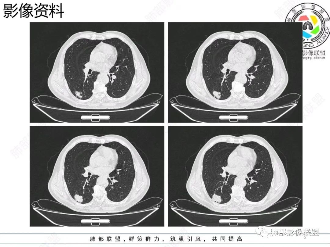 影像PPT - 【病例】胸膜下的混合密度结节—良恶之争-5 影像PPT - 【病例】胸膜下的混合密度结节—良恶之争-5