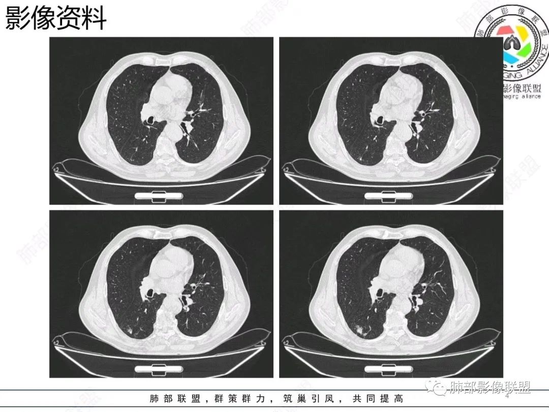影像PPT - 【病例】胸膜下的混合密度结节—良恶之争-4 影像PPT - 【病例】胸膜下的混合密度结节—良恶之争-4
