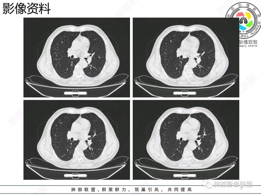 影像PPT - 【病例】胸膜下的混合密度结节—良恶之争-3 影像PPT - 【病例】胸膜下的混合密度结节—良恶之争-3