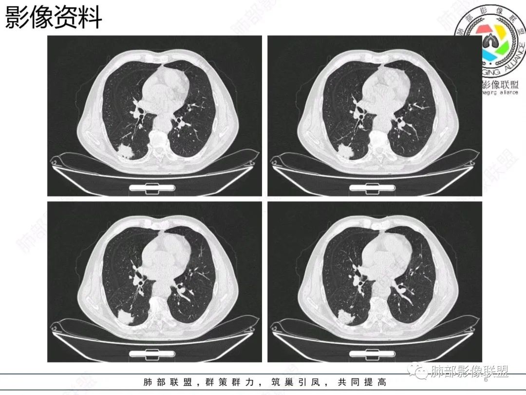 影像PPT - 【病例】胸膜下的混合密度结节—良恶之争-6 影像PPT - 【病例】胸膜下的混合密度结节—良恶之争-6