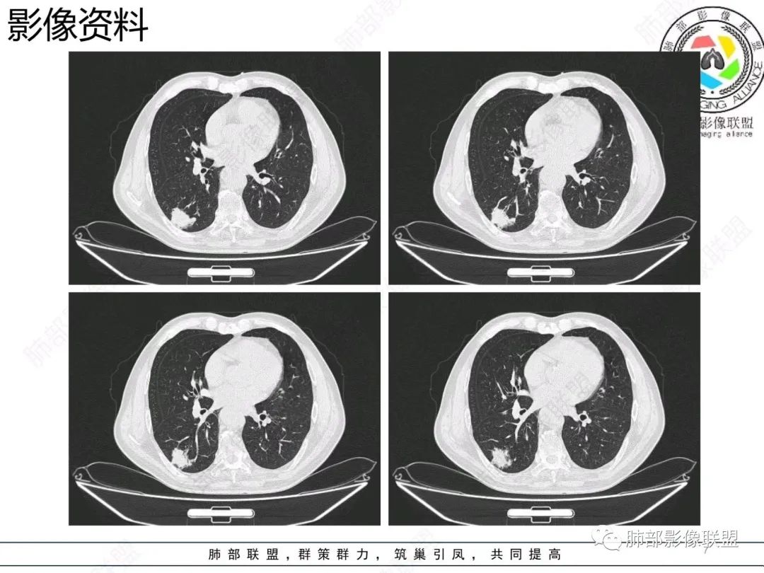 影像PPT - 【病例】胸膜下的混合密度结节—良恶之争-7 影像PPT - 【病例】胸膜下的混合密度结节—良恶之争-7