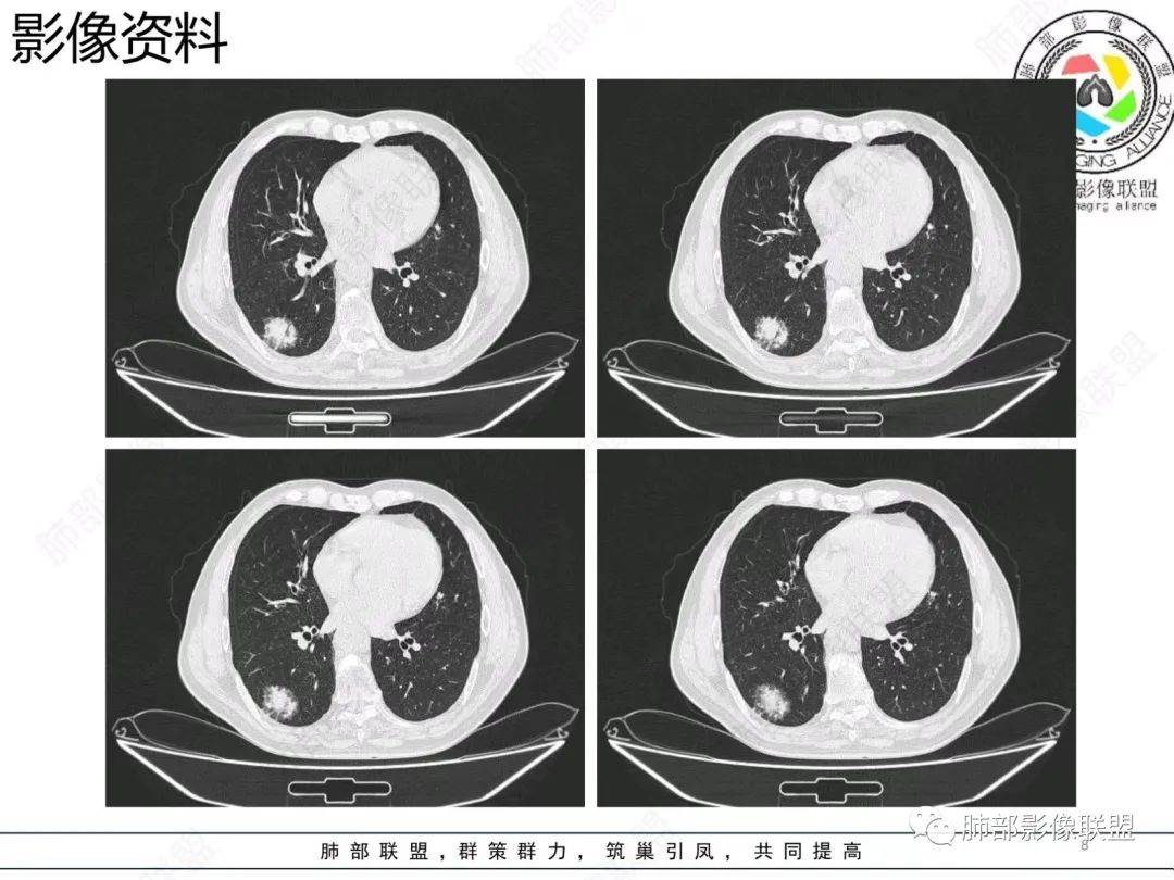 影像PPT - 【病例】胸膜下的混合密度结节—良恶之争-8 影像PPT - 【病例】胸膜下的混合密度结节—良恶之争-8