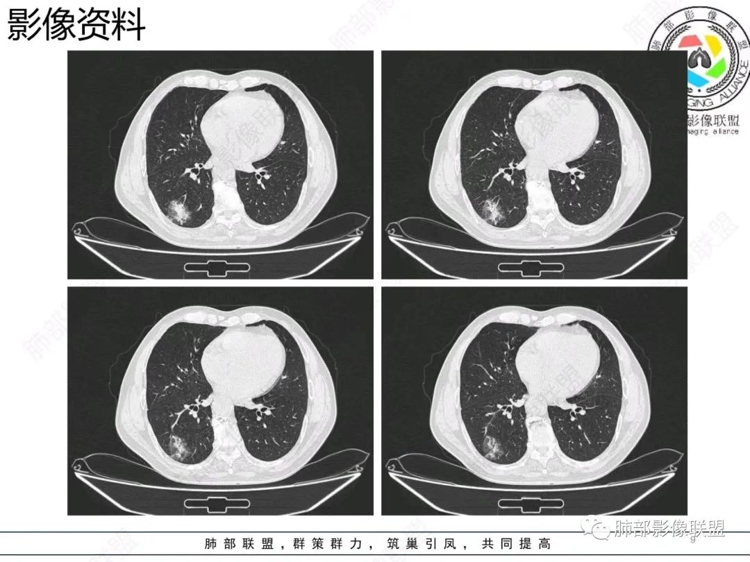 影像PPT - 【病例】胸膜下的混合密度结节—良恶之争-9 影像PPT - 【病例】胸膜下的混合密度结节—良恶之争-9