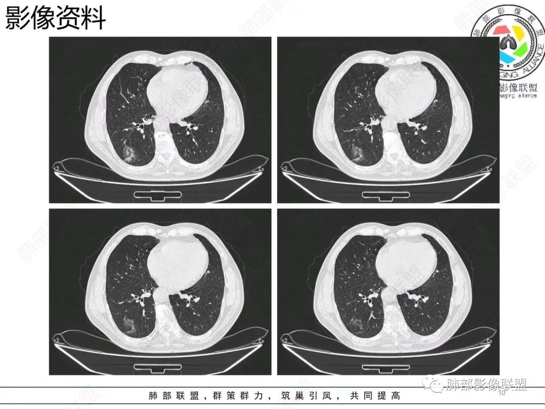 影像PPT - 【病例】胸膜下的混合密度结节—良恶之争-10 影像PPT - 【病例】胸膜下的混合密度结节—良恶之争-10