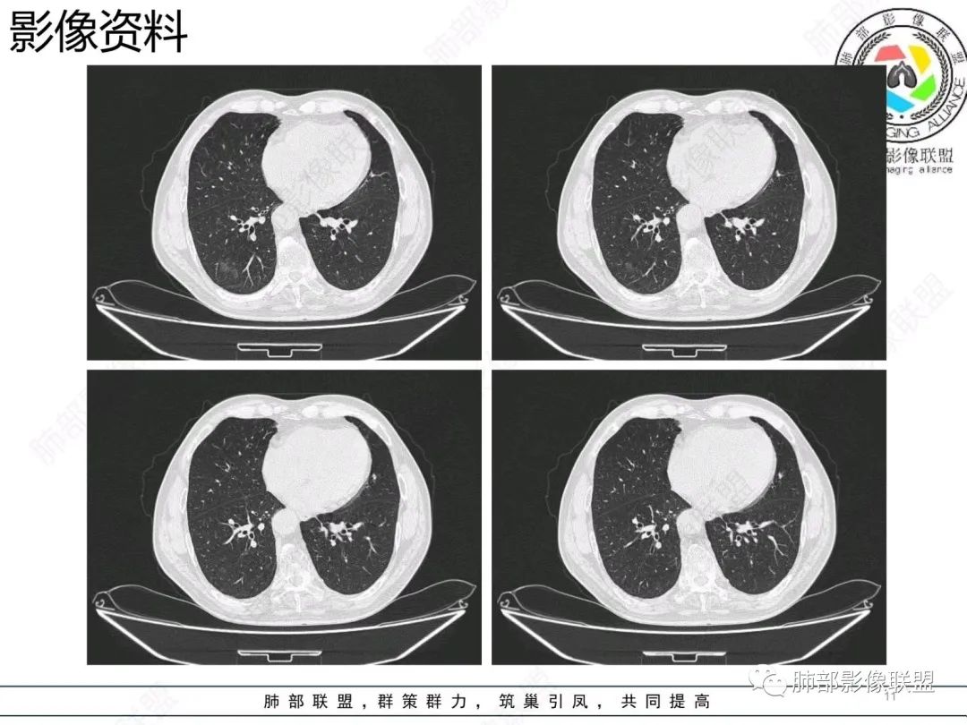 影像PPT - 【病例】胸膜下的混合密度结节—良恶之争-11 影像PPT - 【病例】胸膜下的混合密度结节—良恶之争-11